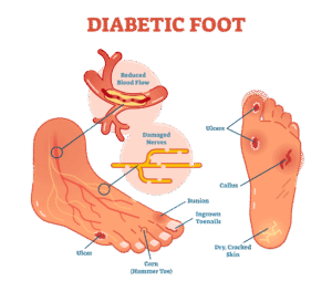 Nursing Management of Diabetic Foot