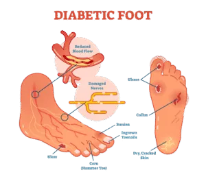 Nursing Management of Diabetic Foot