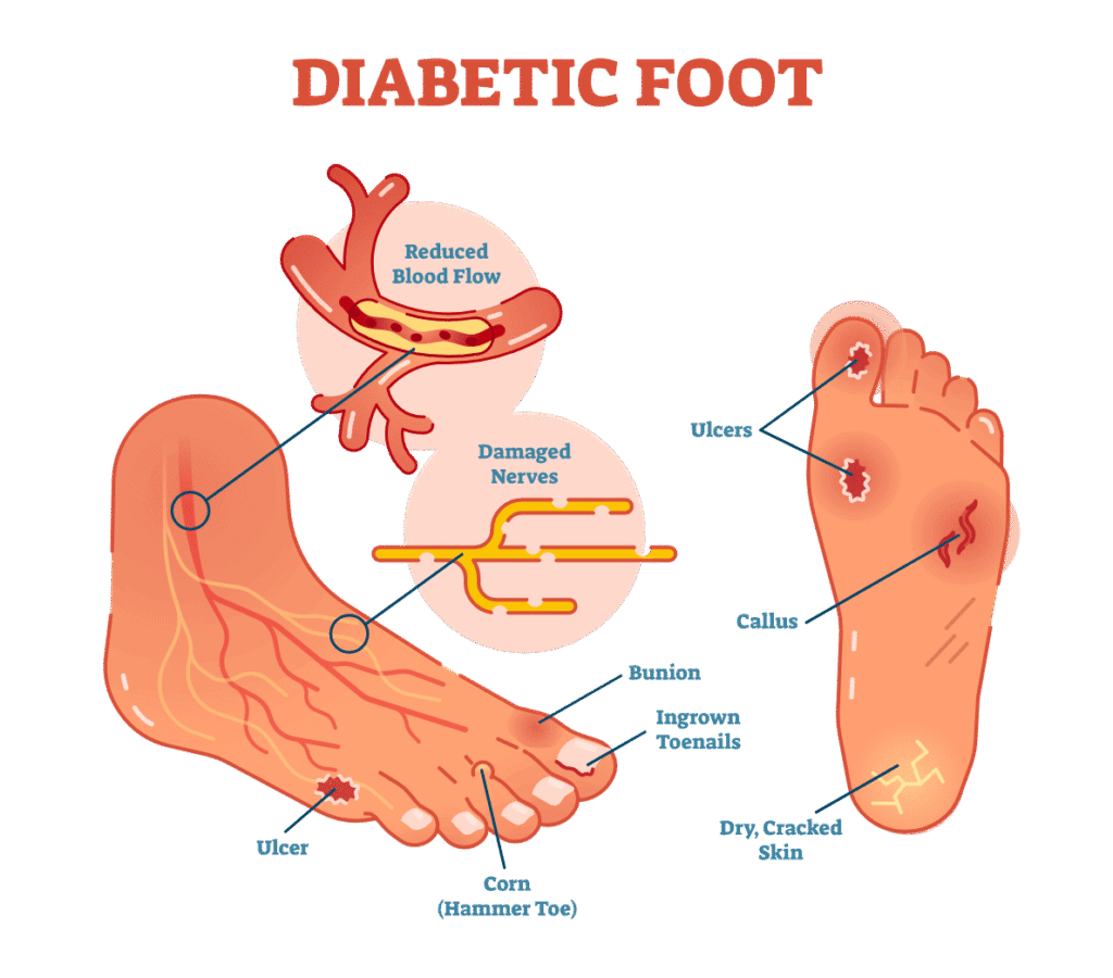 Nursing Management of Diabetic Foot