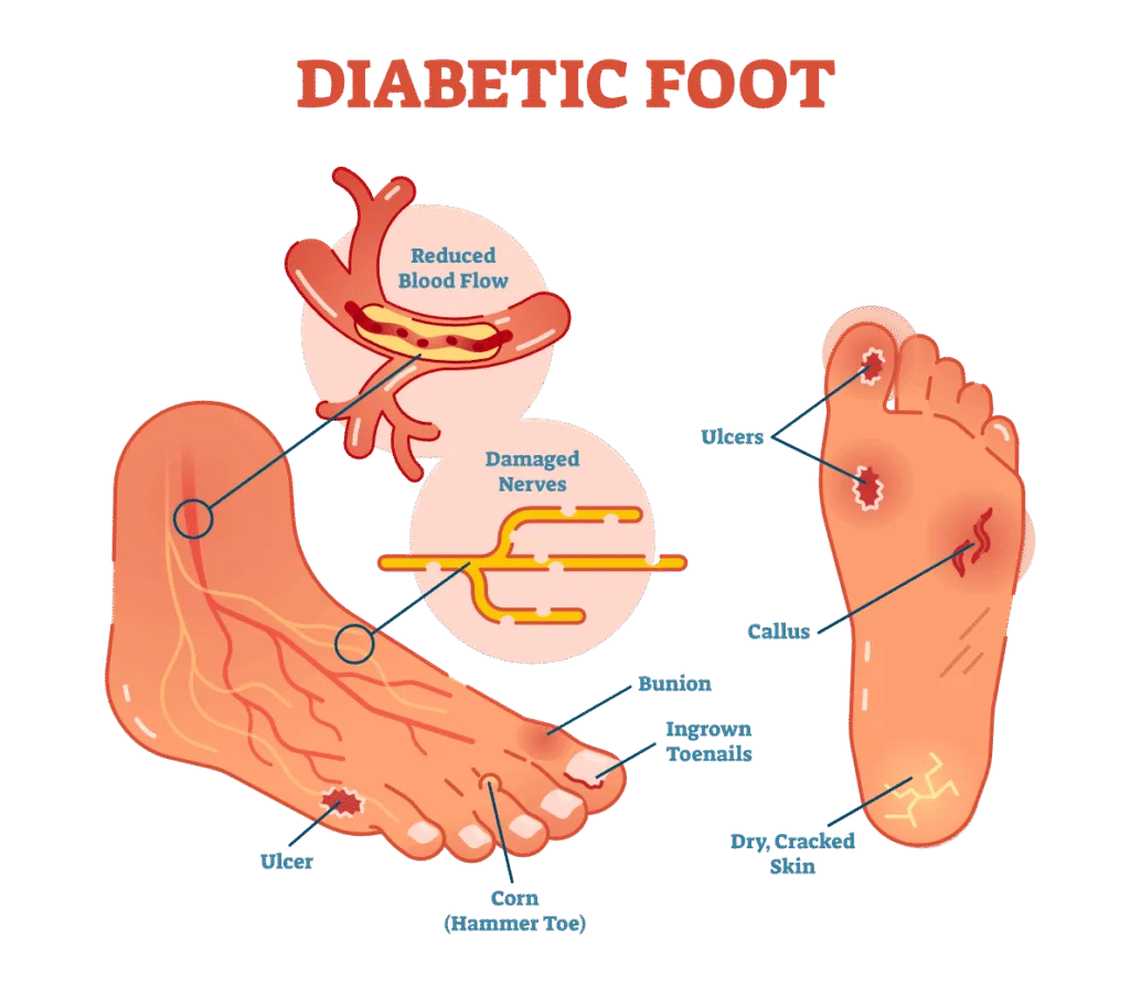 Nursing Management of Diabetic Foot
