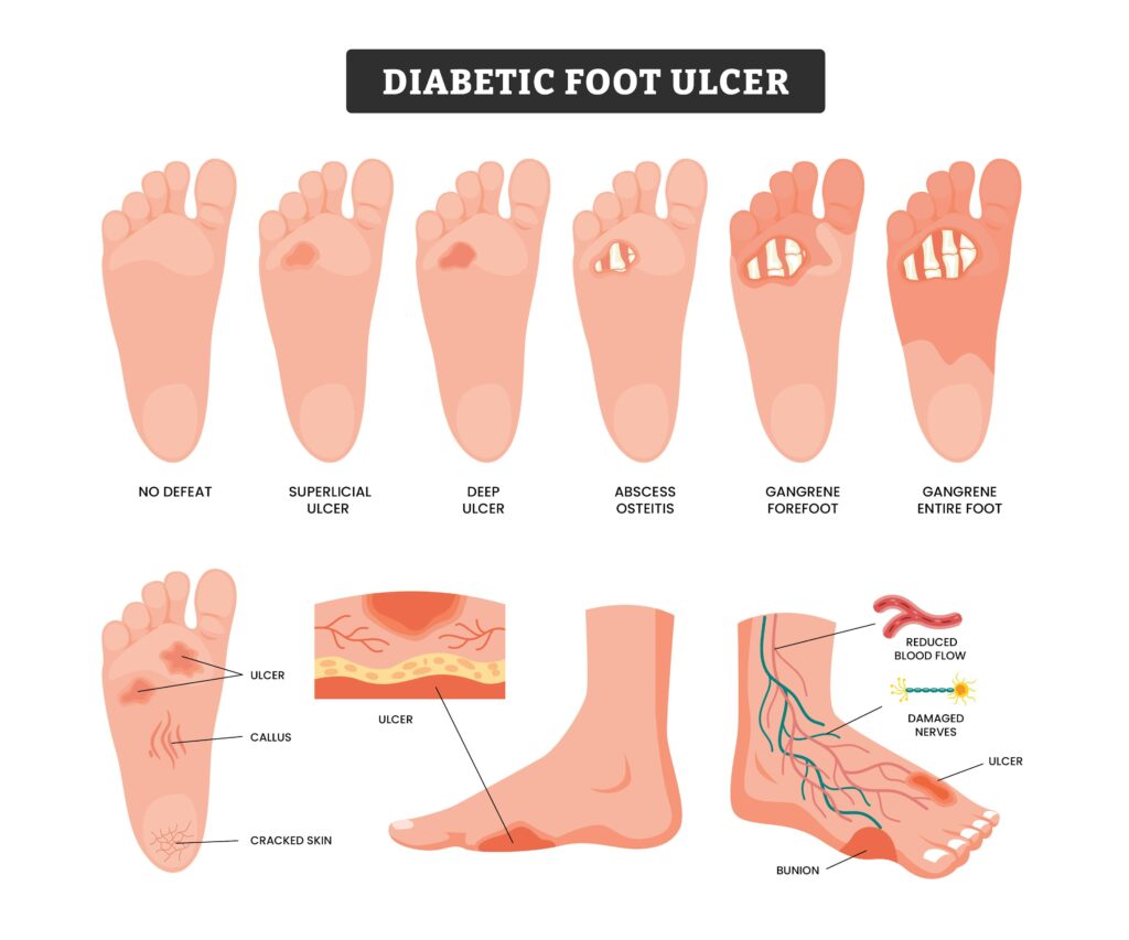 diabetic foot ulcer