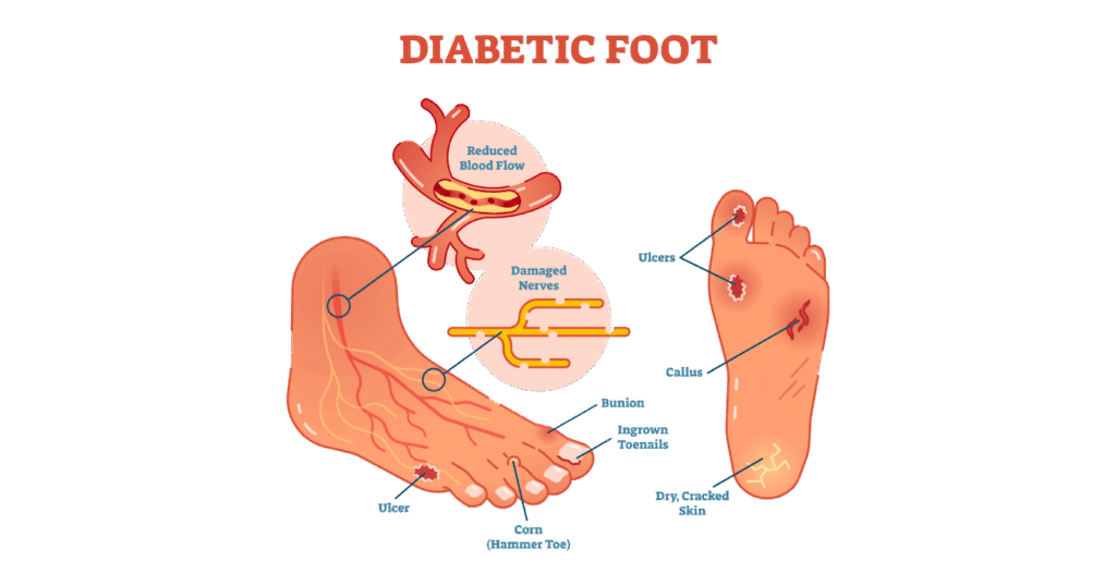 What is Diabetic Foot?