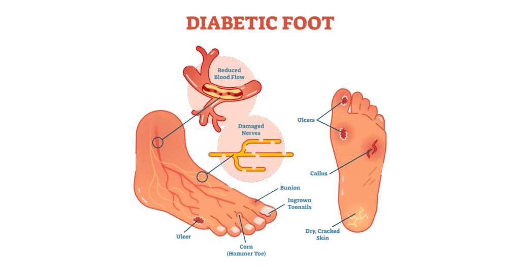 What is Diabetic Foot?
