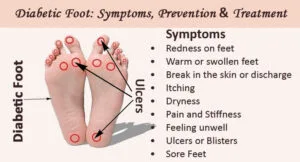 Diabetic Foot Care: Prevention, Symptoms & Treatments