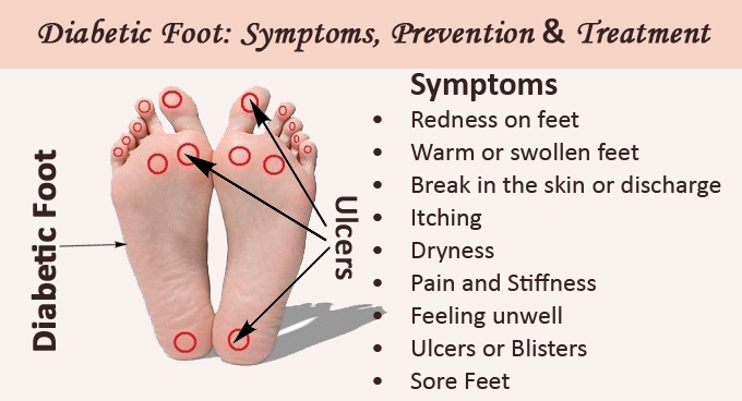 Diabetic Foot Care: Prevention, Symptoms & Treatments