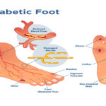 Why Diabetic Foot Care in Vizag Cannot Wait