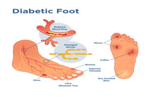 Why Diabetic Foot Care in Vizag Cannot Wait