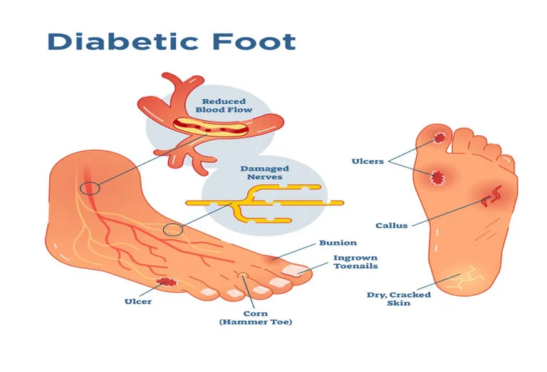 Why Diabetic Foot Care in Vizag Cannot Wait