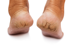 Cracked Heels Diabetes:Perspective on Causes, Care & Prevention