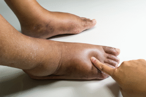 Diabetic Feet Swelling: Doctor’s Guide to Causes & Care