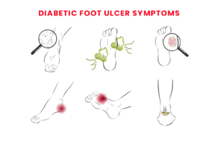 Foot Ulcer Symptoms: Perspective on Early Detection and Care