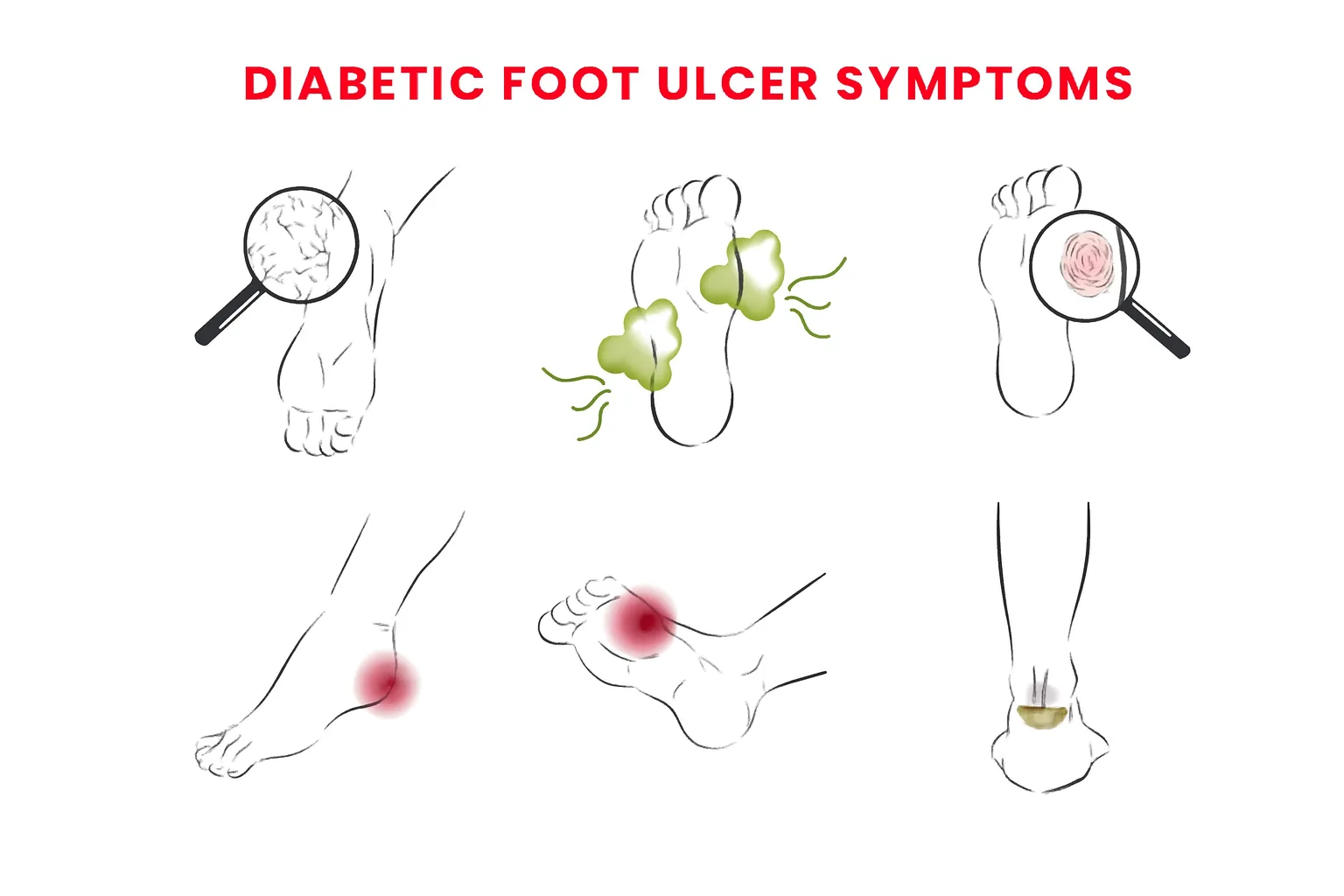 Diabetic Foot ulcer symptoms