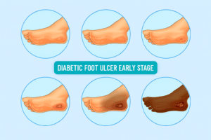 Diabetic Foot Symptoms: From Early Warning Signs