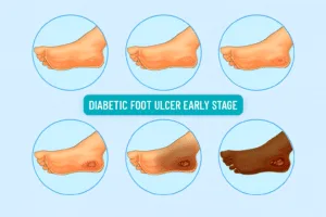 Diabetic Foot Symptoms: From Early Warning Signs