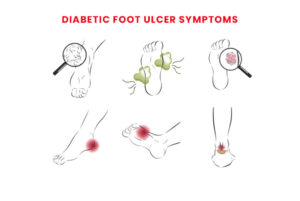 Foot Ulcer Symptoms: Perspective on Early Detection and Care