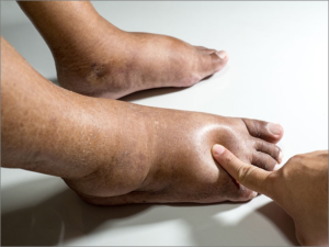 Diabetic Feet Swelling: \Doctor’s Guide to Causes & Care
