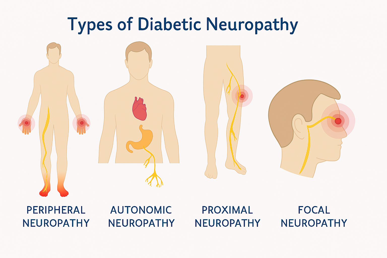 Types of Diabetic Neuropathy
