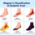 Wagner’s Classification of Diabetic Foot: The Complete Guide