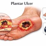 Plantar Ulcer: Causes, Treatment, and How to Heal Faster