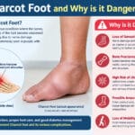 What is Charcot Foot and Why is it Dangerous?  Guide to This Serious Diabetic Complication